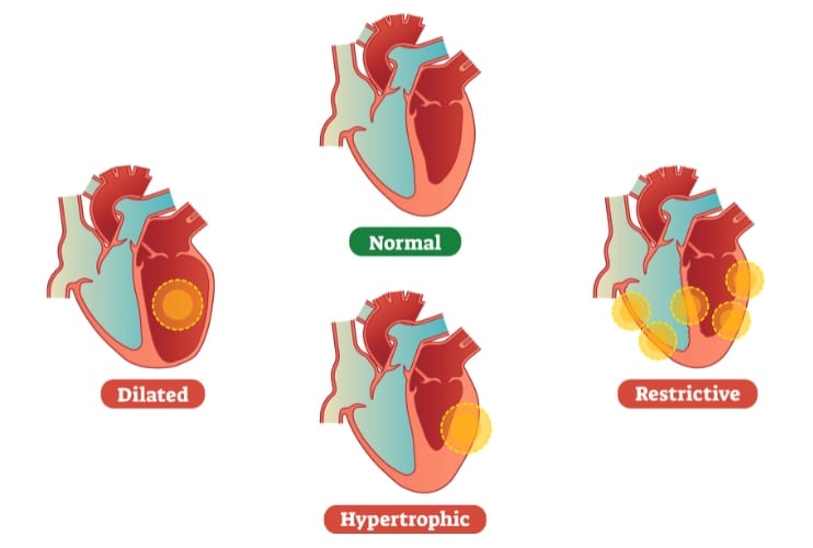 Cardiomyopathy